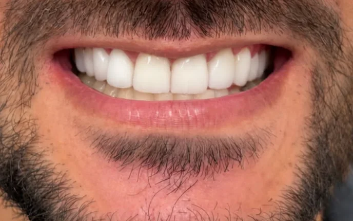 Sorriso de paciente depois das lentes em resina